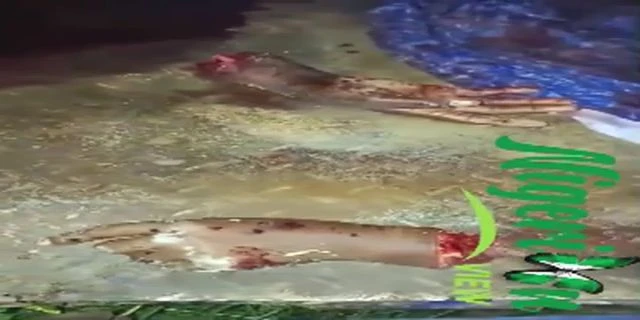 Nigerian Bandits Cut Off Both Hands Of A Woman